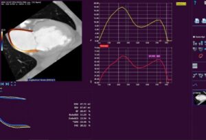 Medis Suite CT Atrial Strain