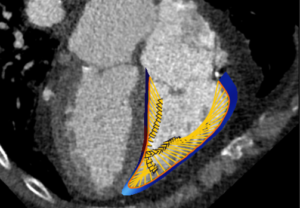 Medis Suite CT – RV strain