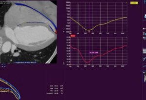Medis Suite CT RV Strain