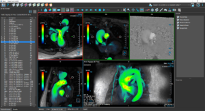 Medis Suite MR Clinical Applications 4D Flow