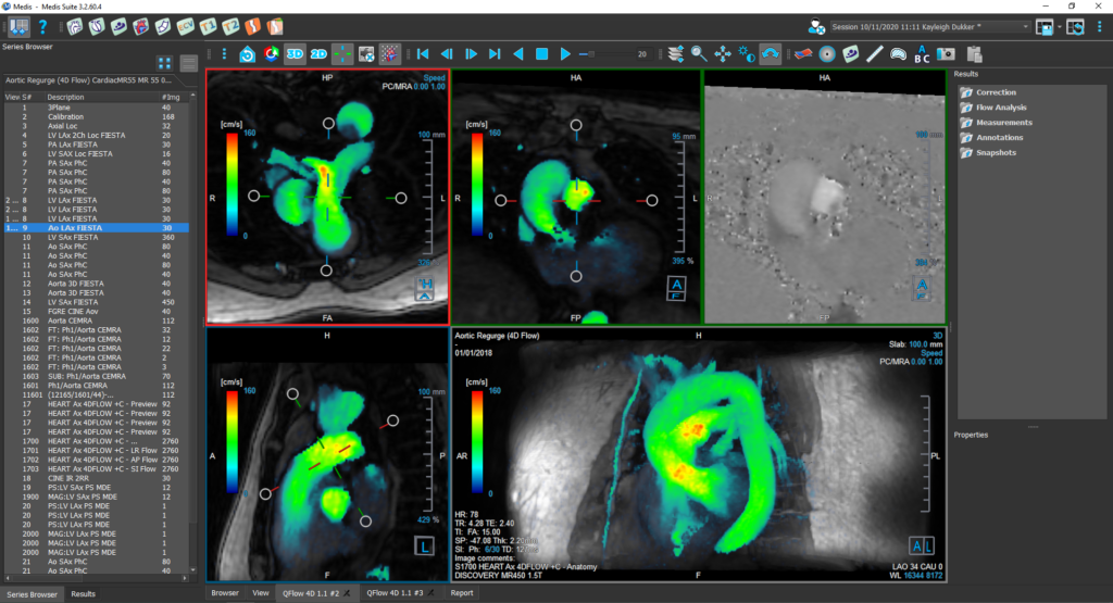 Medis Suite MR Clinical Applications 4D Flow