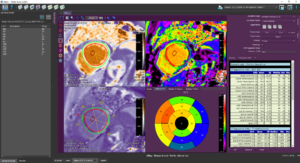 Medis Suite MR Research Apps Extracellular Volume Research