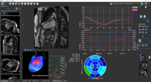 Medis Suite MR - LV Strain Clinical