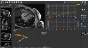 Medis Suite MR Clinical applications RV Strain