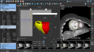 Medis Suite CT – LV/RV Function photo illustration