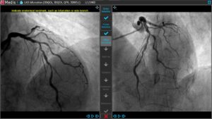 Medis Suite XA 3D QCA Bifurcation1 3 Offset Correction