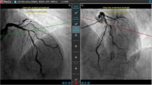 Medis Suite XA 3D QCA Single Vessel 3 Offset Correction