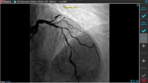 Medis Suite XA 3D QCA Single Vessel 3 Pathline 2D