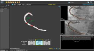 3D QCA Single Vessel