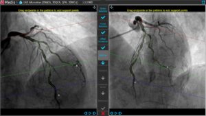 Medis Suite XA 3D QCA Bifurcation4 4 Pathline