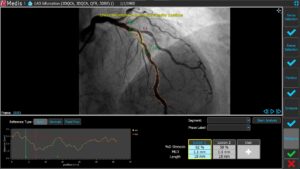 Medis Suite XA 3D QCA Single Vessel 5 Reference 2D