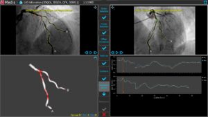 Medis Suite XA 3D QCA Bifurcation2 6 Correspondence