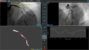 Medis Suite XA 3D QCA Single Vessel 6 Correspondence