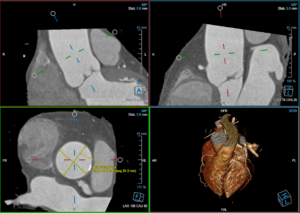 Medis Suite CT – 3D View MPR