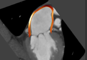 Medis Suite CT – Atrial strain