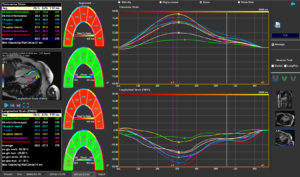Medis Suite MR - LV Strain Module 4