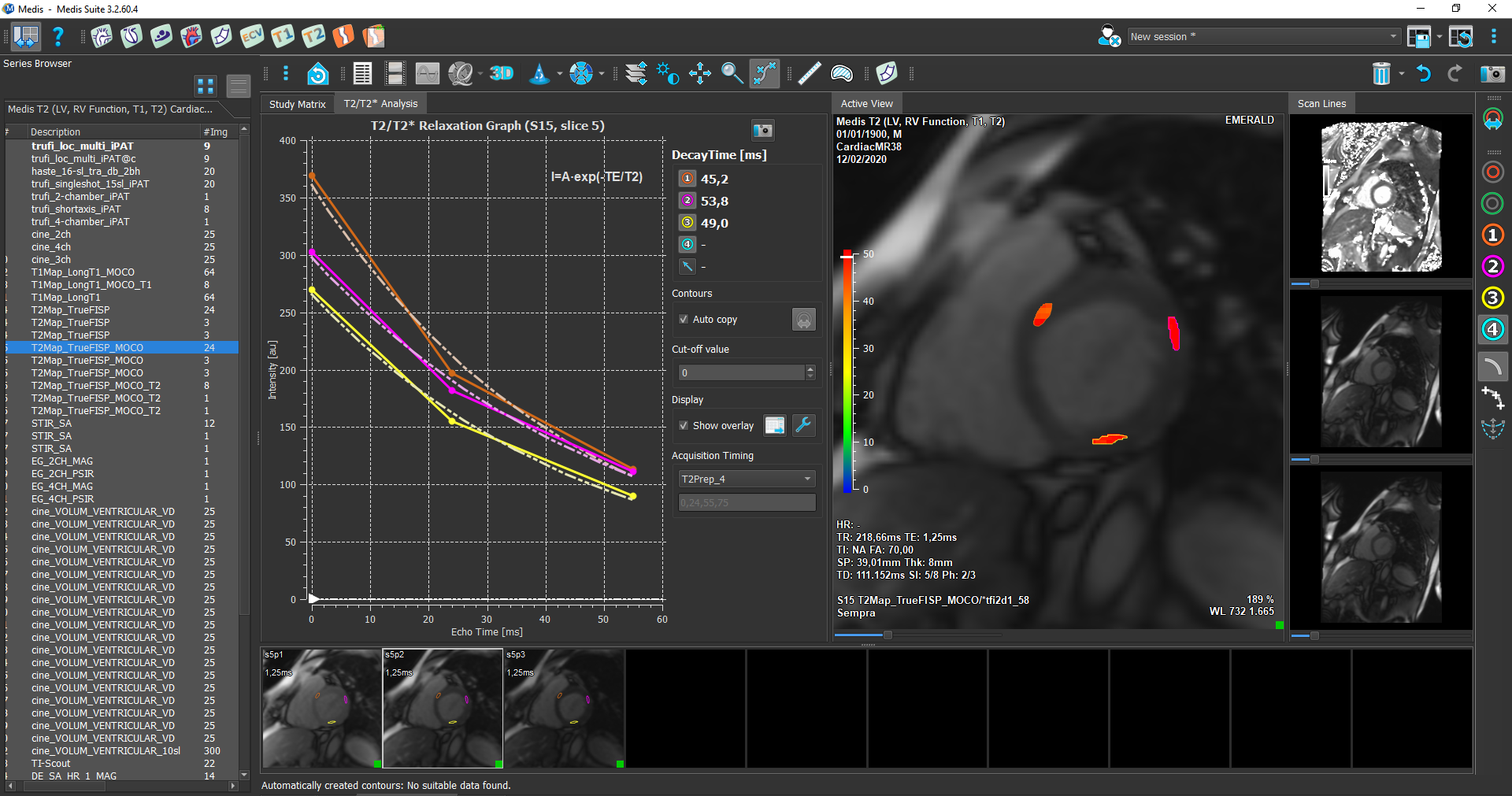 Medis Suite MR – T2/T2* analysis