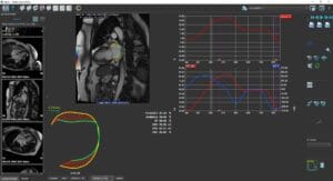 New atrial strain