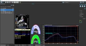 New atrial strain
