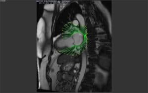 New atrial strain