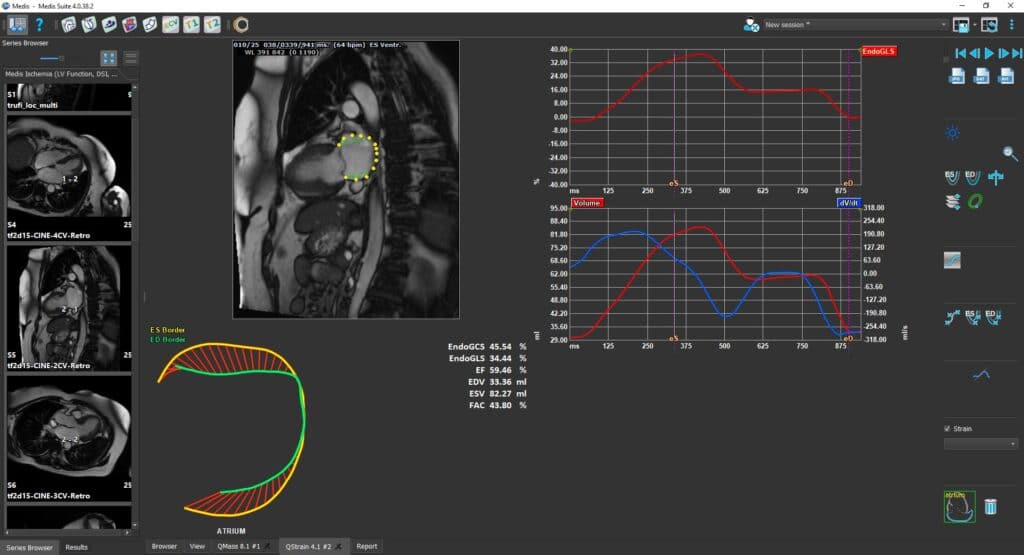 New atrial strain