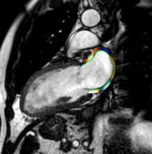 New atrial strain