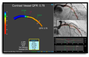 Medis QFR product screen image